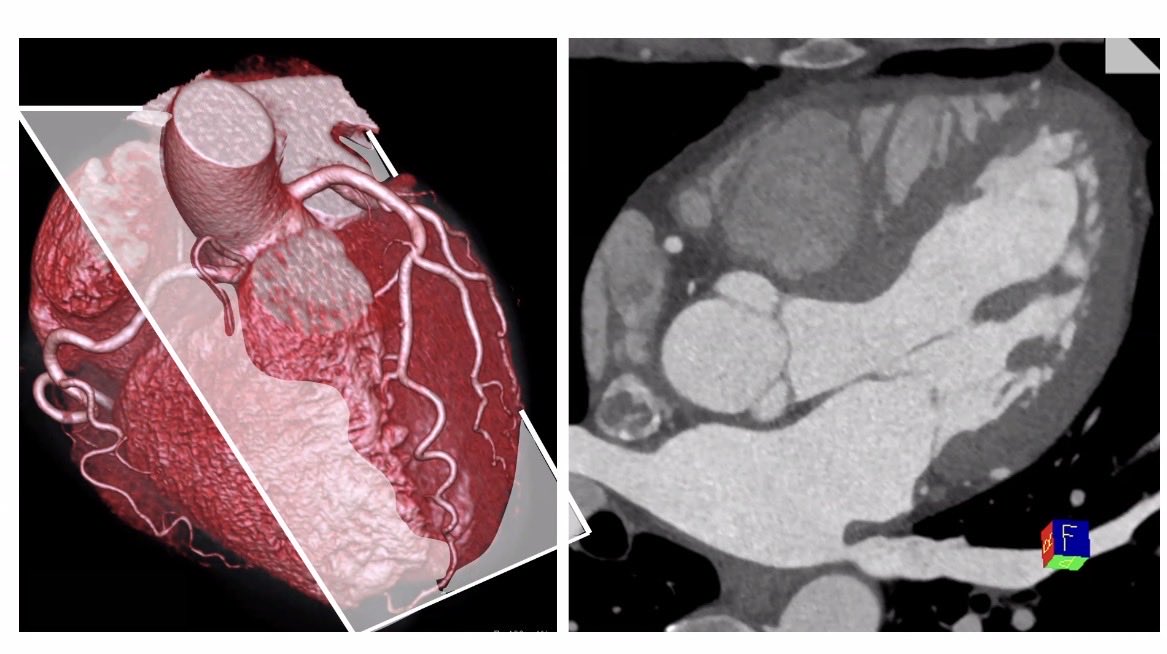 hvanspall's tweet image. Brilliant interactive #GrandRounds at #McMasterU by Prof Stephan Achenbach
on #CardiacCT

Benefits:
-Spatial &amp;amp; temporal resolution perfect for structural interventions
-Calcium accurately depicted 
-🫀devices not major problem
Limitations
-RA visualization 
- blooming artifact