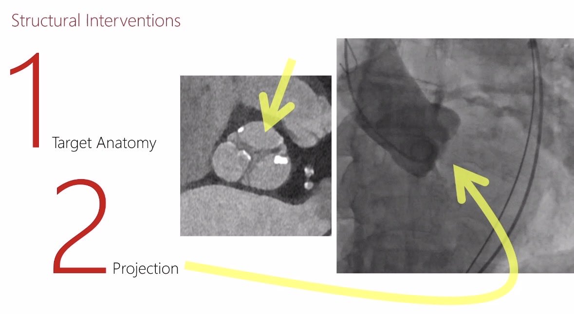 hvanspall's tweet image. Brilliant interactive #GrandRounds at #McMasterU by Prof Stephan Achenbach
on #CardiacCT

Benefits:
-Spatial &amp;amp; temporal resolution perfect for structural interventions
-Calcium accurately depicted 
-🫀devices not major problem
Limitations
-RA visualization 
- blooming artifact