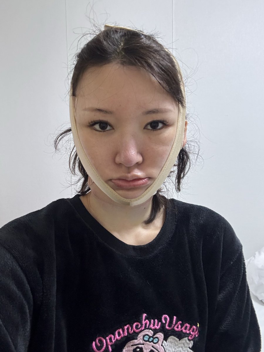 odecochandayo's tweet photo. とうとう切開リフトしてきたよ！切開リフト＋ネックリフト＋ペリカン手術＋魔女顎手術とフルコースでした。ほんとはペリカンと魔女顎する予定なかったんだけど、全然調べてなかったからこれが一番やりたい部位で横転(整形垢が知ったらおこだね)あと案の定元気です。なぜ？ https://t.co/MAka3PbXf2