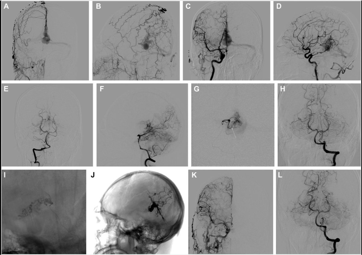 NeurosurgeryCNS's tweet photo. #NEUNew Intracranial Dural Arteriovenous Fistulas With and Without Pial Artery Supply: Analysis of Treatment Outcomes https://t.co/CqPWkfRuV7 by Su et al at Xuanwu Hospital, Capital Medical University, Beijing @CNS_Update @visishs @dgolubMD https://t.co/aEPD4i5XHu
