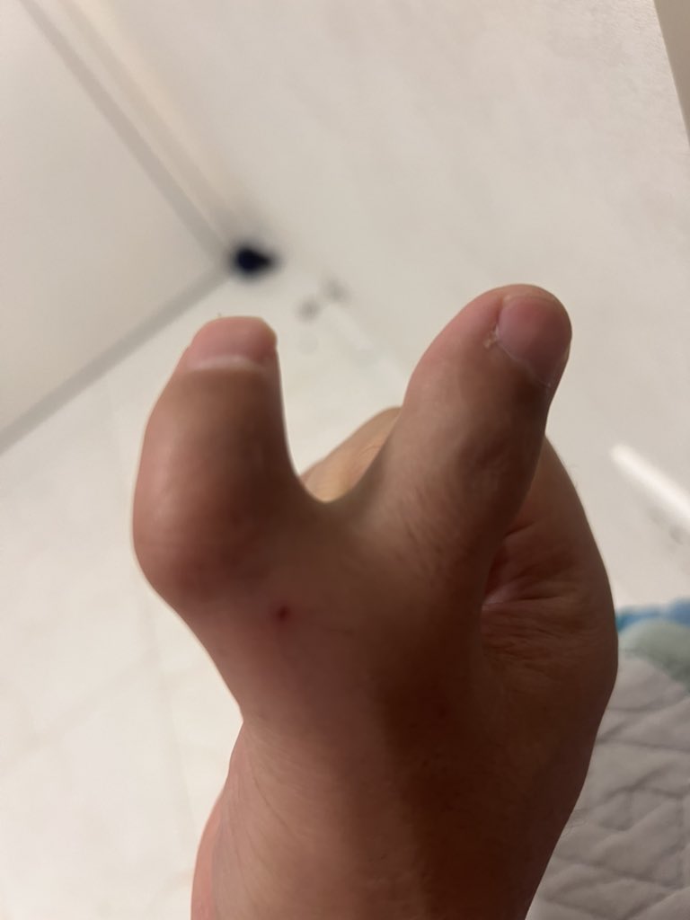 ahmedjun2018's tweet photo. @wufantouzi 我多进化了一个大拇指🤪 https://t.co/dkvLRTc686
