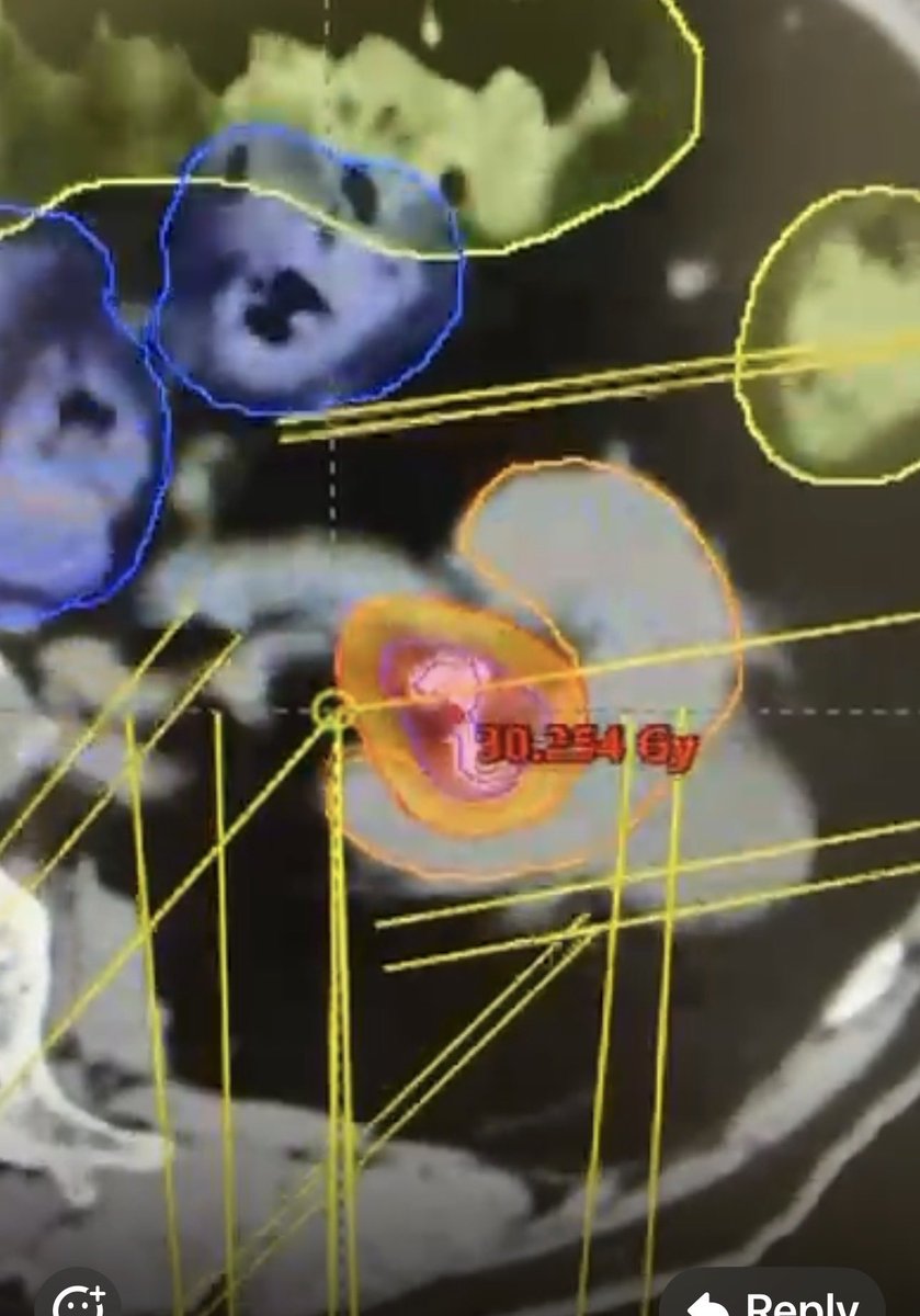 Melvin LK CHUA | FRCR, PhD, FASCO tweet media