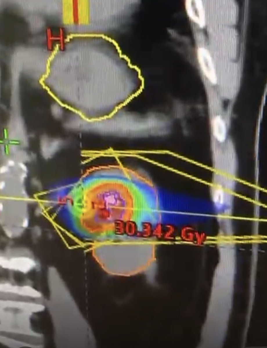 Melvin LK CHUA | FRCR, PhD, FASCO tweet media