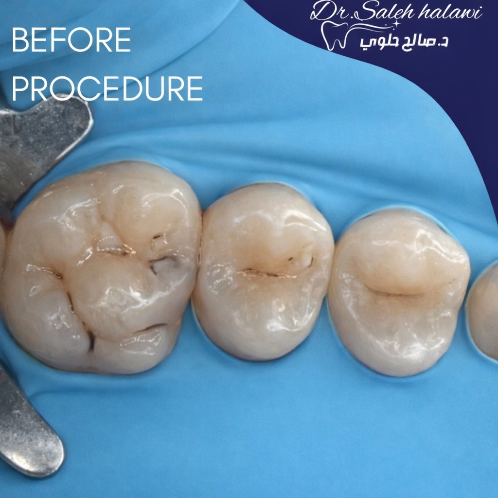 Class II composite restoration under rubber dam isolation, class I caries excavation and restoration on the next visit.👏🏻#operative #dentist #dentistry