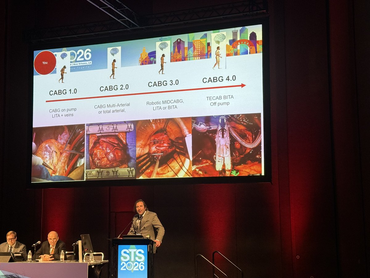 GianTorre610's tweet photo. Great discussion during #STS2026 around barriers to increase adoption in #RoboticCABG. Robotic as platform to maximize use of #BITA in all comers and revascularize left coronary system: how to get there https://t.co/s8UfpaHYs0