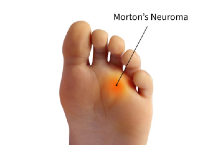 When the Toes Send a Sharp Signal dlvr.it/TQkfYw