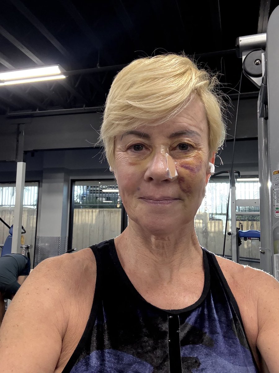 PaulaMaier3's tweet photo. My face looks like it got whacked with a sack of pennies, but I’m here at the gym doing an easy rate. This is where my people are.❣️
#mohs #akincancer #skincare #sunscreen #wearahat https://t.co/wlHipCWcA1