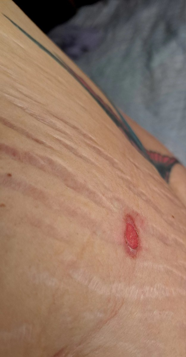 InkedDeviant's tweet photo. Didn't Realize I Got A Blistered Burn On My Tummy From Cooking The Other Day - Accidentally Touched My Soup Pot When Reaching Into My Spice Cupboard That's Above My Stove.
...That Looks Kinda Angry...🤨
#Ouch #UPW https://t.co/LCFIxbZBs0
