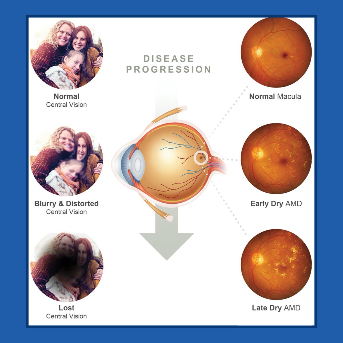 Eye Surgeons of Indiana tweet media