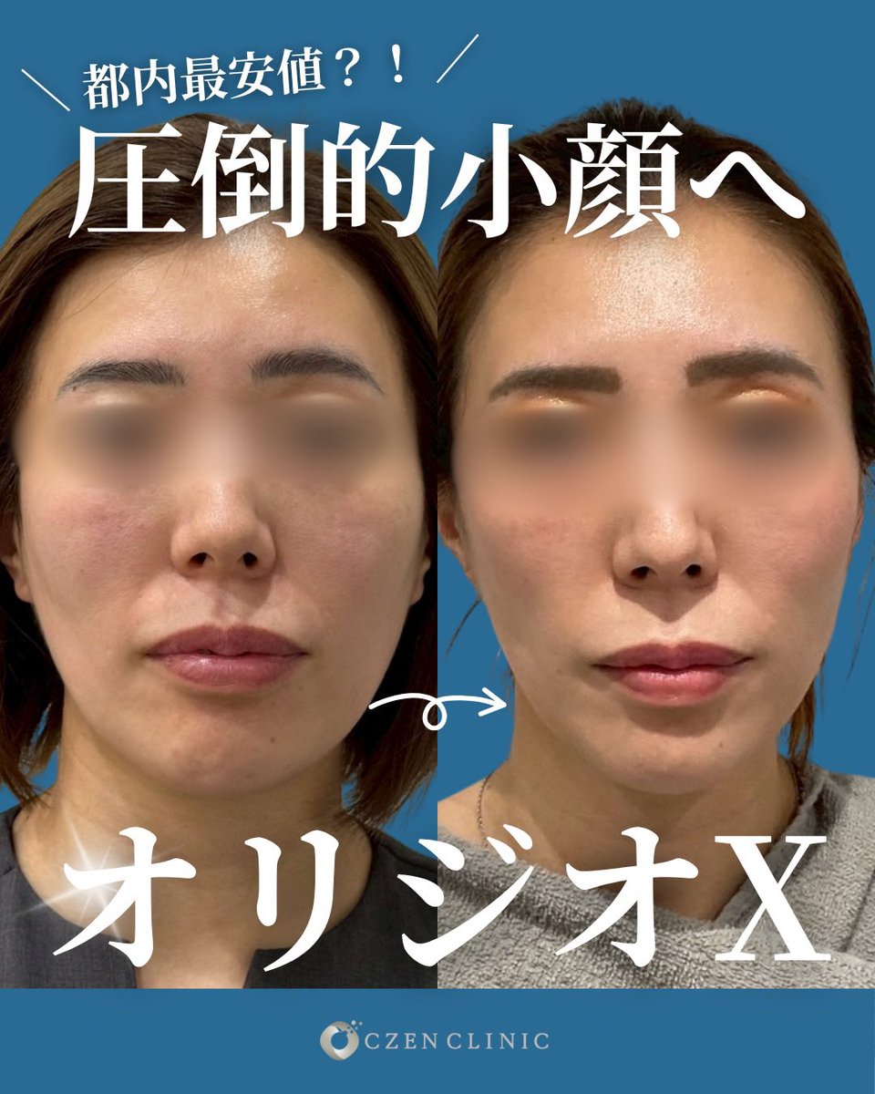 切らずにリフトアップ！オリジオX✨ ＼ 進化したRF（高周波）で、美肌