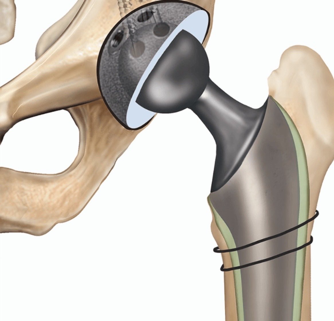 TeenaGates's tweet image. Had my big hospital appointment about my hip placement today.  I’ve lost 5 stone but I need to lose SEVEN MORE.  Finished the day back in the gym.  #DreamDareDo #titanium