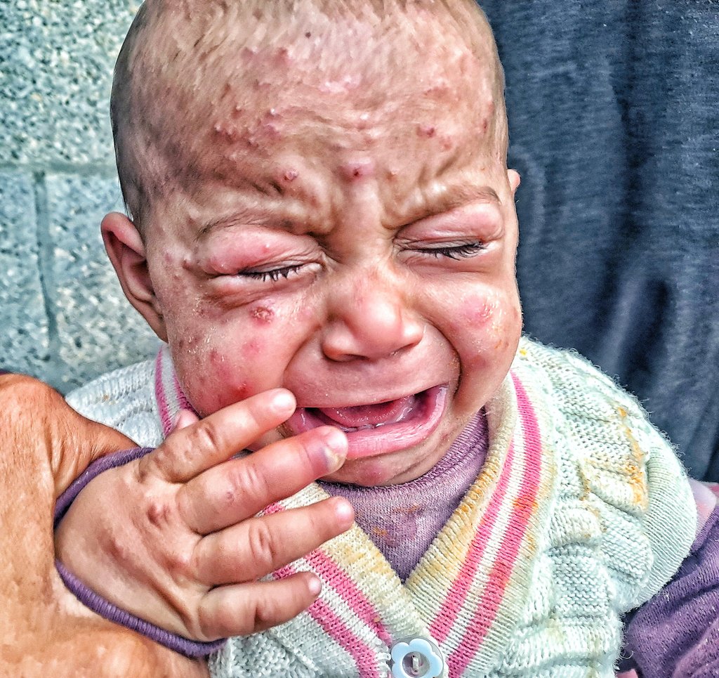 mahmoud60013's tweet image. Tasneem’s life is in danger. Her skin disease has worsened again and continues to spread. Tasneem is crying, and both of her eyes are swollen and painful, making it difficult for her to open them, rest, or sleep. She cries because the burning never stops, and because the itching…