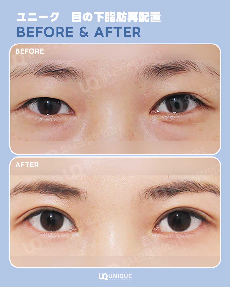 unique__jp's tweet image. #ユニーク美容外科
#目の下脂肪再配置💎

目の下の脂肪で
メイクするときも不満…💦

疲れて見える印象を
綺麗になくしましょ💙

無料オンラインカウンセリング•ご予約は
✉️ line.me/ti/p/ASaI14sy4x

#目整形 #目再手術 #症例写真 #韓国整形