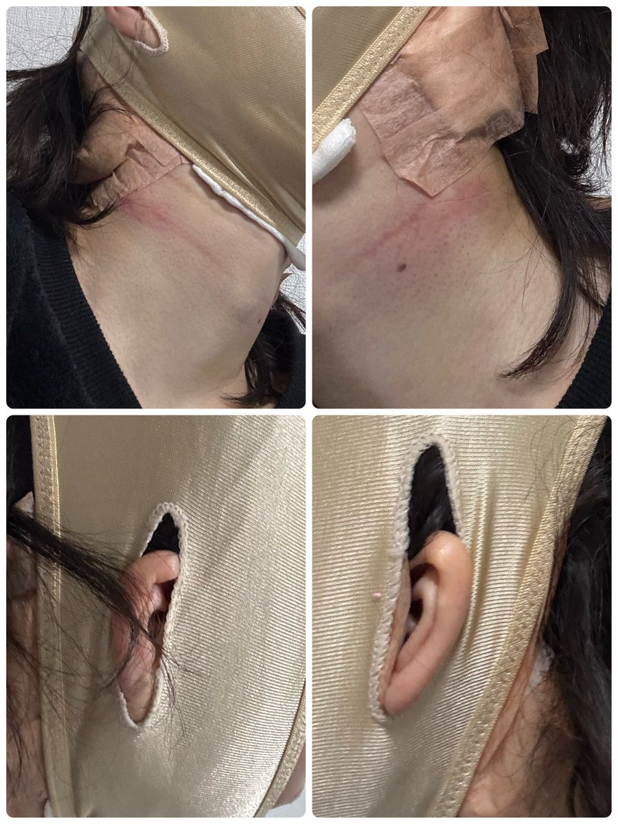odecochandayo's tweet photo. 切開リフト＋ネックリフト＋ペリカン手術＋魔女顎手術DT1日目朝。
浮腫んでるねぇw唇オバケになると思って昨日の夜散歩がてらオリヤンでラネージュのリップスリーピングマスク買ってきたんよね。
こいつまじで乾燥しないからこれでもかってくらい塗って寝た。プルプルのままよ https://t.co/wvM0R9hNK0