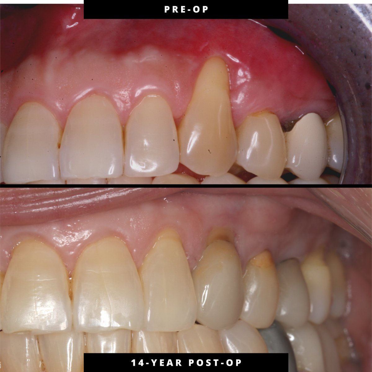 JohnChaodds's tweet photo. Tooth #11 | Pinhole® Surgical Technique | 2011 procedure, 14.5-year follow-up (2026). Stable margin position with maintained soft-tissue thickness and contour. https://t.co/PAzjMD7Qbw