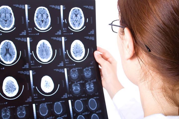 Study: Help for Brain Injury.
A 2009 randomized, double-blind, placebo-controlled trial demonstrated that individualized homeopathy led to significant improvements in people with mild traumatic brain injury — even years after the event. Participants, struggling with persistent