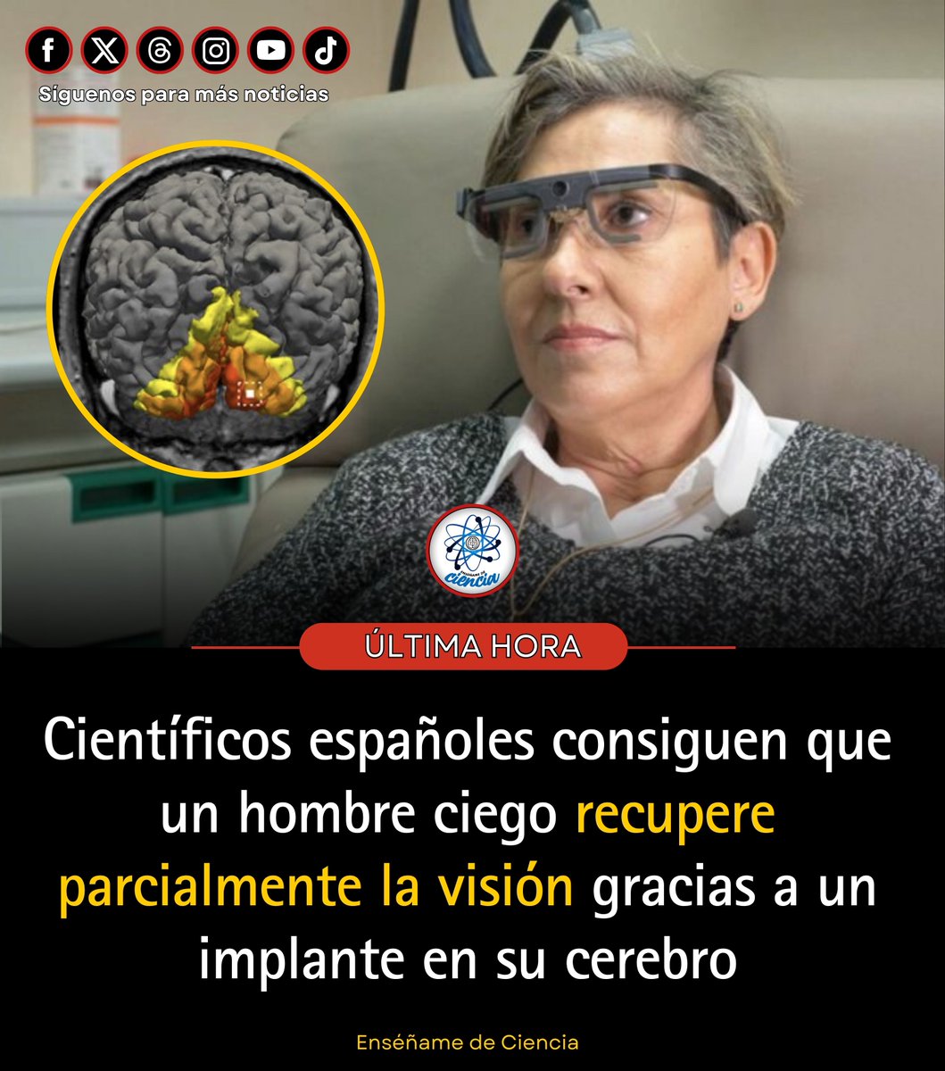 EnsedeCiencia's tweet photo. Científicos de la Universidad Miguel Hernández (Elche, España) lograron que Miguel Terol, ciego desde 2018 por daño en el nervio óptico, recuperara parcialmente la visión de forma natural.

Le implantaron temporalmente (6 meses) 100 microelectrodos en la corteza visual para probar una prótesis cerebral. Inesperadamente, a los 2 días ya veía luces, movimientos, formas, objetos e incluso letras grandes… ¡sin activar el dispositivo!

Tras retirar el implante, la mejora persiste: tres años después distingue sombras, movimiento y formas básicas.

El estudio (Brain Communications, 2026) sugiere que la estimulación reactivó circuitos neuronales o impulsó plasticidad cerebral.

No es visión normal, pero es un caso único y muy esperanzador. 🧠✨