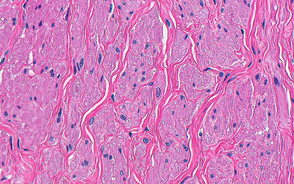 ziad_zaatari's tweet image. 🔬📸 "River Delta" ~ Bladder Neck Smooth Muscle ~ #Pathology #Histology #GUpath #PathArt