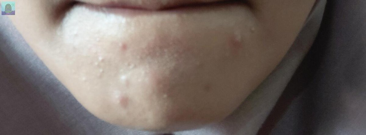 tanyakanrl's tweet photo. 💚 CW/ jerawat
Kulit aku kaya gini terus banyak jerawat mendem juga😭 gimana yaa padahal sender rajin kok exfo pake elformula 2x seminggu.. kayanya karena sender baru nyoba cushion nya omg deh😭 https://t.co/eaSWTYg52j