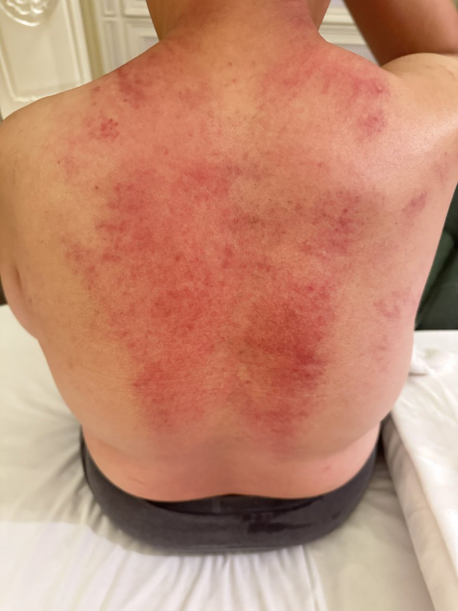 eff09333's tweet image. 謝謝花蓮的你來按摩調理，半年沒有見了，也聽到換了更好工作替你開心的事。
好好走出自己👀片天空，學會主動溝通聊天，這樣才會有好的桃花戀愛。
總是按完後回家好睡覺。
有酥麻爽爽感受。筋膜刀ㄧ定會酸痛而已
但是也會讓你身體代謝乾淨排尿更好