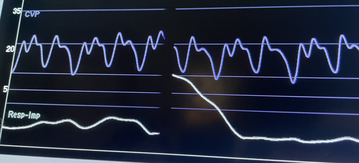notkillingeve's tweet image. 33F with severe Group I PAH, in ICU on three vasopressors and CRRT. You see this CVP waveform on the bedside monitor. Look closely- what do you see? @emcrit #pulmcrit #criticalcare (CVP as an entity aside)