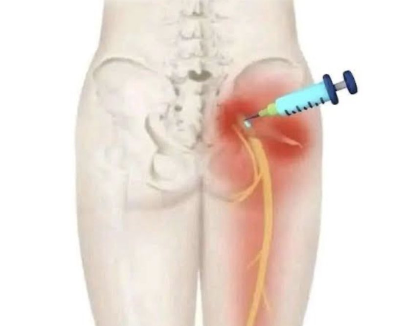 Are You The Type That Once You’re Sick Or Someone Around You Is….You Rush To The Nearest Chemist Shop Or Roadside “Nurse” For An Injection?

Walk with me. Let’s talk about Injection Palsy 👇

WHAT IS INJECTION PALSY?

Injection palsy is nerve damage caused by a wrongly