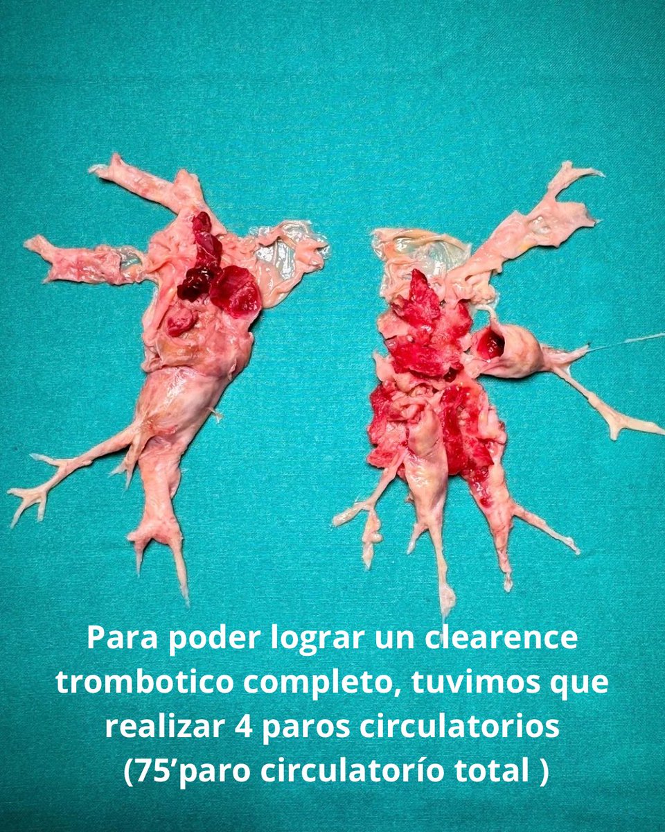 marcelo_nahin's tweet photo. Surgical quality control was performed using SPECT-CT before discharge. Complete revascularization of both lungs can be observed.

#pulmonaryendarterectomy https://t.co/9SeSBeVd86