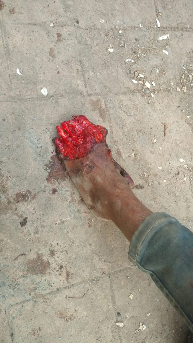ua_shirin's tweet photo. Urgent‼️pls help this person near the copper hospital — is lying there post an accident.
A call few mints ago from the area to me said the #cooperhospital too won’t help to take him 
@AmeetSatam @rupeshsarkar 
#ward61
@mybmcwardKW 
This is the second incident in less than 10 days where the hospital won’t cooperate 
Ameet ji kindly help and request the hospital to provide him required support. 
Tushar - +91 91 671 328 38 is there helping the man 
Location below 👇🏻 
https://t.co/tGdy6adXHI