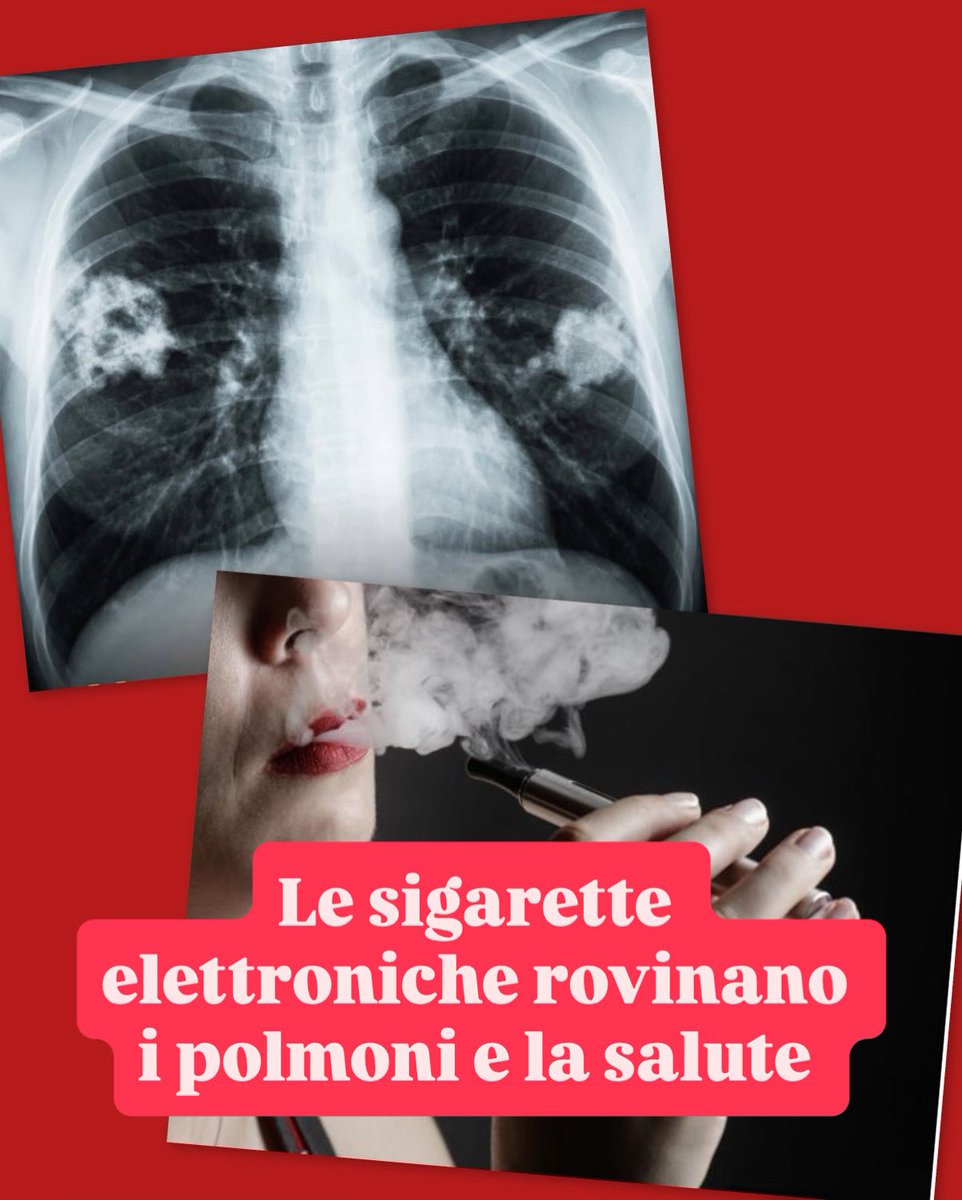 Li vedete quei segni bianchi nei polmoni? 
Sono gli effetti delle sigarette elettroniche. 
Ormai è noto a livello medico, e non solo. Le sigarette elettroniche aromatizzate causano danni polmonari permanenti.
Negli Stati Uniti, molti adolescenti hanno sviluppato una patologia
