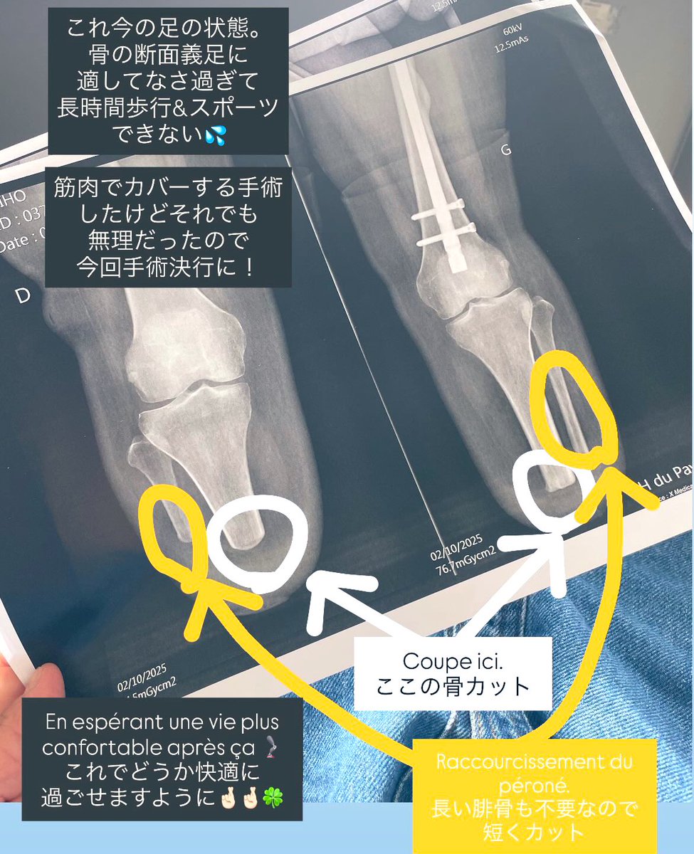 MiHO📍南仏🇫🇷/ 突然の両脚義足生活 tweet media