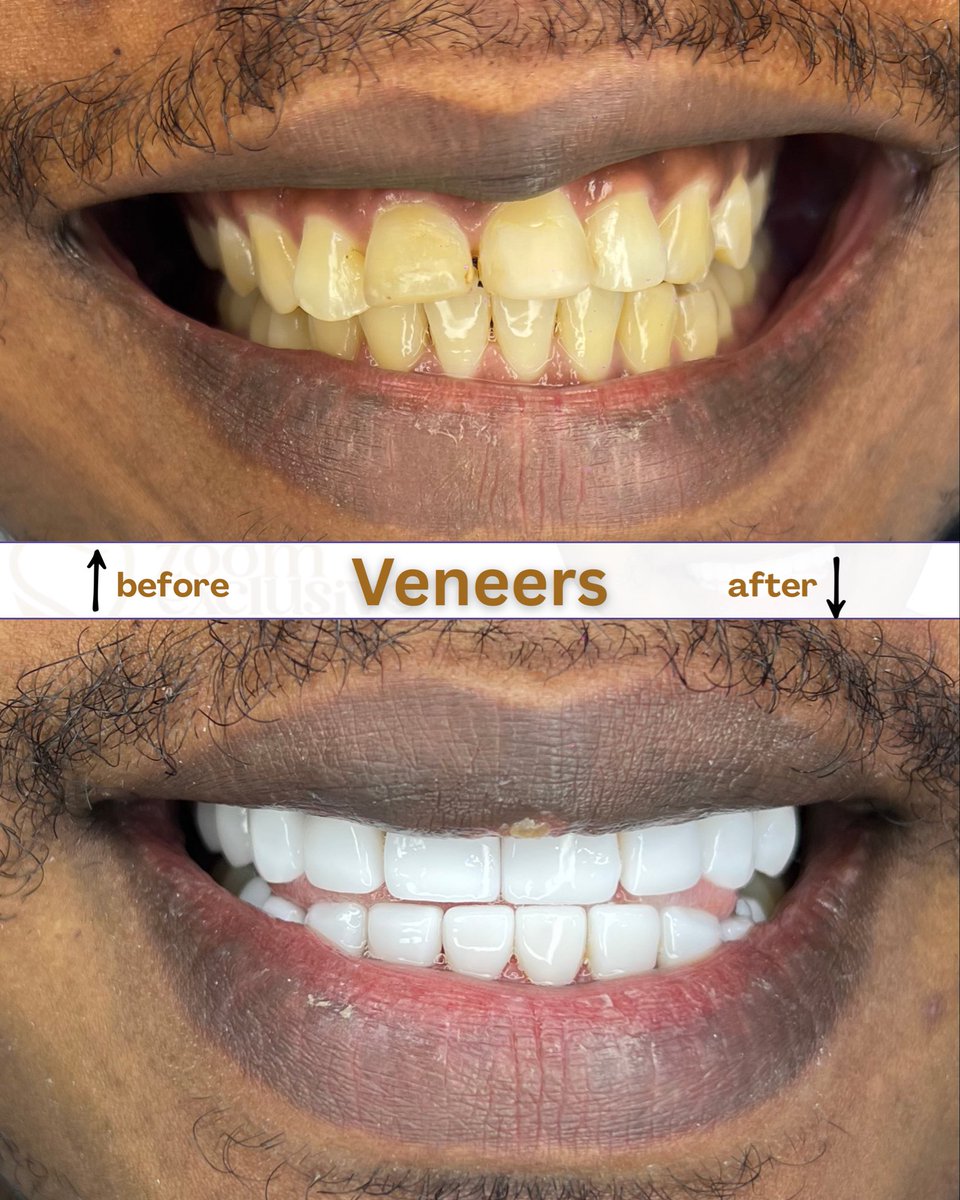 zoomxclusiveng's tweet image. Before: discolored, uneven teeth with an unbalanced smile.

After: bright, well shaped veneers that restore symmetry, confidence, and a clean smile line

#veneers #smiletransformation #cosmeticdentistry #zoomexclusive