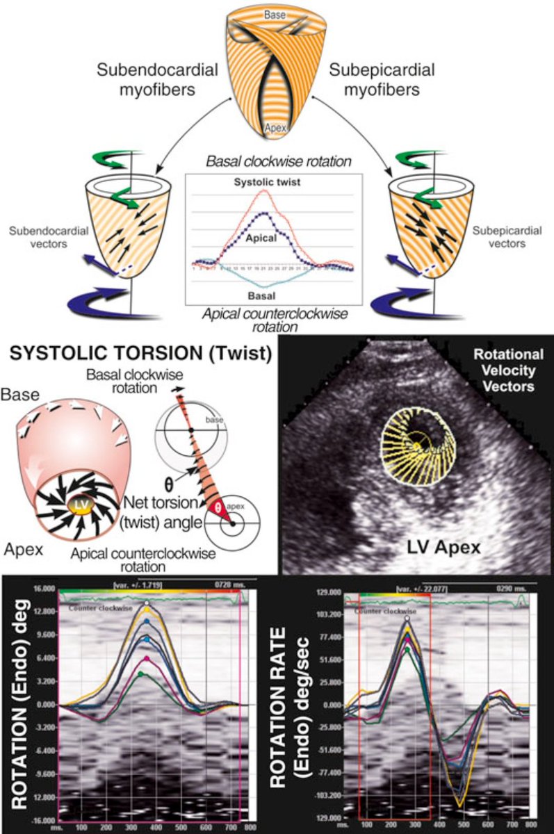 TrackYourHeart's tweet photo. LV Torsion: A Powerful Marker of Systolic Function
Definition
Left ventricular (LV) torsion (or twist) refers to the wringing motion of the heart during systole, apical counterclockwise rotation vs basal clockwise rotation.
It results from the unique helical arrangement of subendocardial and subepicardial fibers.
How is it measured?
Using speckle-tracking echocardiography, torsion is calculated as the net difference in rotation between apex and base, typically in degrees.
We can also measure the rate of rotation (deg/sec), offering further functional insight.
Why does it matter?
Torsion reflects myocardial efficiency and contractile function.
It is sensitive to:
π΅ Early systolic dysfunction (even with preserved EF)
π΅ Myocardial ischemia and infarction
π΅ Cardiomyopathies (HCM, DCM)
π΅ Heart failure (including HFpEF)
Reference:
Modified from Bulwer BE, Solomon SD. In: Atlas of Echocardiography, 2nd ed. Springer; 2009:63.