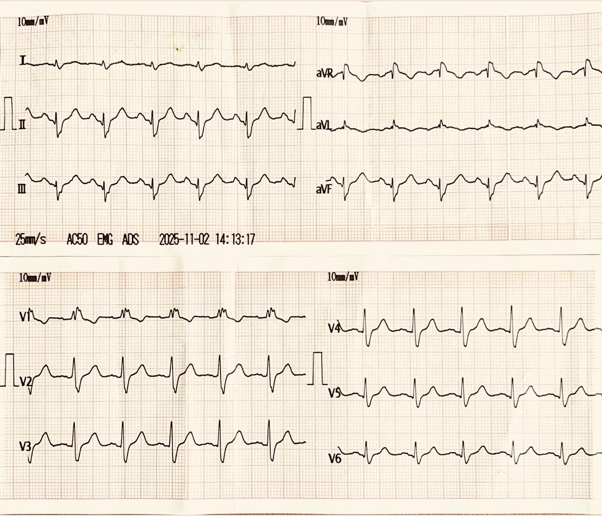 mRafiHamidi's tweet photo. 80YM w/ no typical chest pain, presented with generalized weakness. ECG &amp; TTE were advised.
The ECG showed unusual changes (as below), while TTE was within normal limits. He subsequently underwent TMT followed by CAG; both were within acceptable limits.

Your thoughts on ECG? https://t.co/eTTyA1ZJjj
