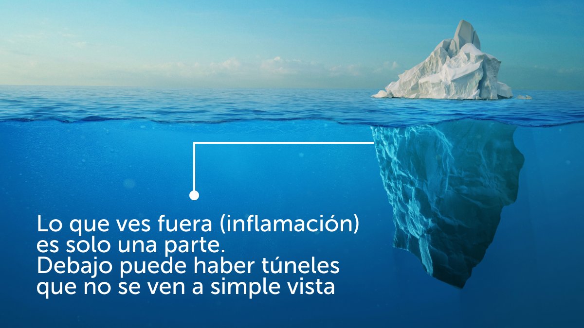 hidradenitishoy's tweet photo. ¿Sabías que la #HS es como un iceberg? 🧊 Lo que se ve fuera no siempre es la realidad.

En el #EHSF2026, expertos como el Dr. Pedro Navarro enseñan a especialistas a usar la ecografía para ver lo invisible y ajustar el tratamiento a la realidad de cada paciente. 🩺💜 https://t.co/ydPY0tBSqG