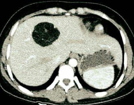 hemo_shk's tweet image. #Radiology 
#Radiologist 

What is the diagnosis?!
Radiological findings?!

#MEDHM #MedX @IhabFathiSulima