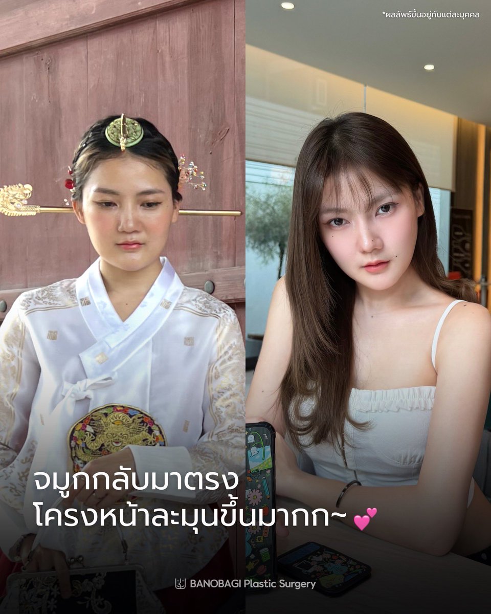 banobagithai's tweet photo. เคสแก้ครั้งสุดท้าย…😖
เจ็บแต่จบ‼️

สวย ครบ จบ ที่บาโนบากิค่ะ 🏥🇰🇷✨
#ศัลยกรรมเกาหลี #รีวิวจริง #แก้จมูก #โครงหน้า #banobagi https://t.co/y96Hj9gpN3