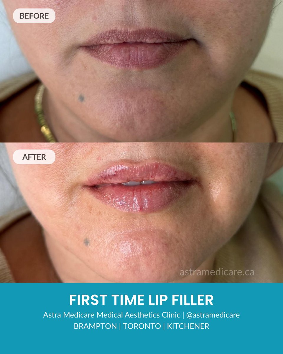 𝑫𝒓𝒆𝒂𝒎𝒊𝒏𝒈 𝒐𝒇 𝒇𝒖𝒍𝒍𝒆𝒓, 𝒏𝒂𝒕𝒖𝒓𝒂𝒍-𝒍𝒐𝒐𝒌𝒊𝒏𝒈 𝒍𝒊𝒑𝒔 𝒇𝒐𝒓 𝒕𝒉𝒆 𝒇𝒊𝒓𝒔𝒕 𝒕𝒊𝒎𝒆? 💋

This before-and-after shows a first-time lip filler treatment performed by Sanda, RN, designed to enhance shape, restore balance, and add subtle volume without