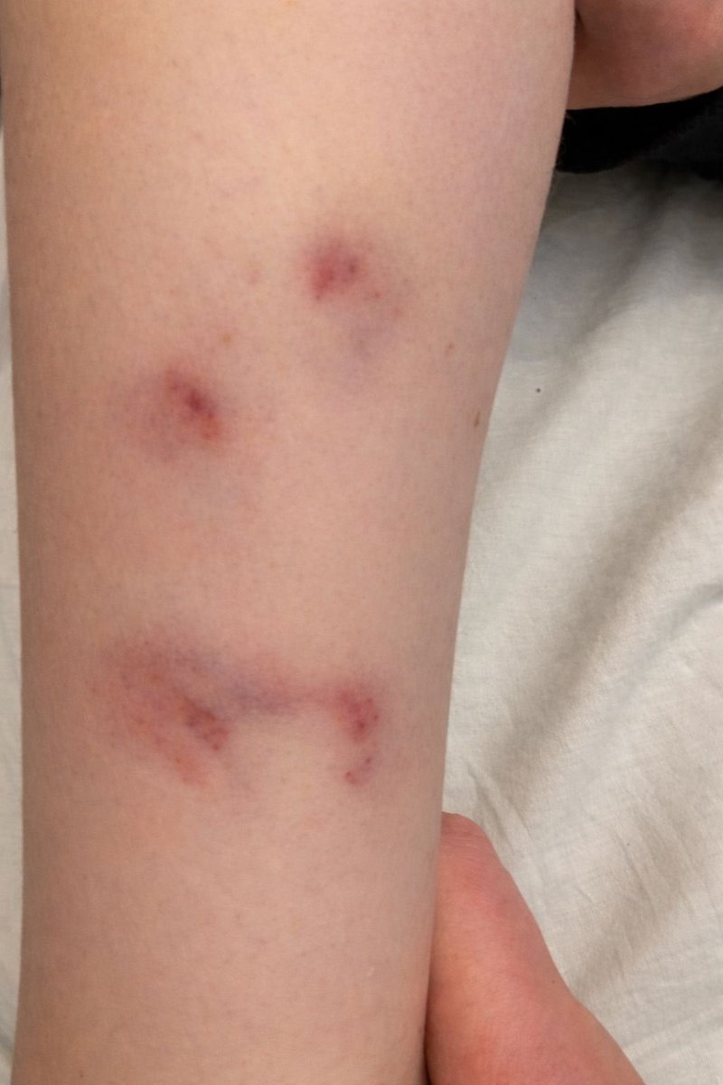 We wanted to share a recent incident from 
City of Gloucester WFC from the weekend to highlight just how important it is that all players wear proper shin pads for both matches and training.

One of our U13 players suffered a heavy stud challenge that resulted in a painful lower