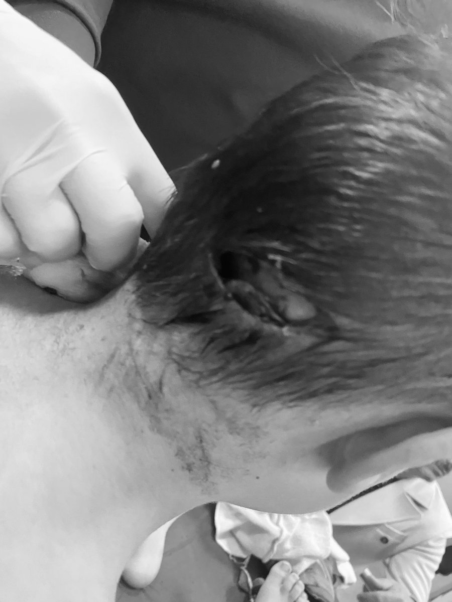 Kafayı yiyeceğim…

Muş/Karaağaç…

‼️5 yaşındaki çoçuk ve annesi KUDUZ BAŞIBOŞ BİR KÖPEĞİN saldırısına uğramış…

Anne Muş’ta hastanede tedavi altında, çocuk Ankara’ya sevk edilmiş hastanede yoğun bakımda…

‼️Çocuk ağır yaralanmış ve baş bölgesinden…

Tüm hukuki haklarını