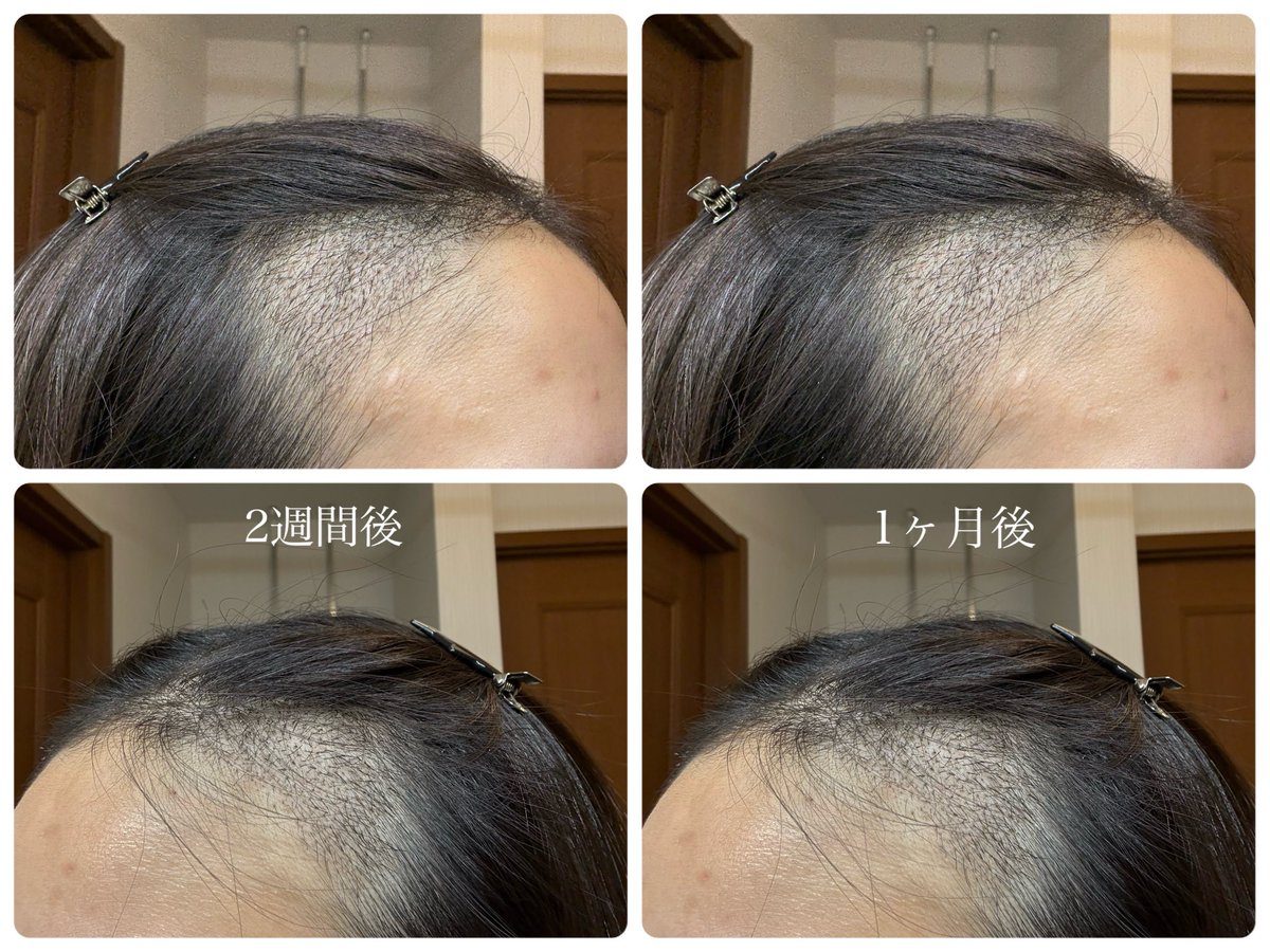 jsnpark25's tweet photo. 植毛1ヶ月後

2~3週間目でフケの量がピークになり、むずむずと痒みもありましたが、毎日しっかり洗って落ち着いてきました。
後頭部の刈り上げ部分もかなり伸びました！
経過観察で院長から「管理が上手にできていますね」と言われ、安心しました☺️
だんだん移植毛が抜けていくのが悲しい🥹 https://t.co/eB597rQaQE