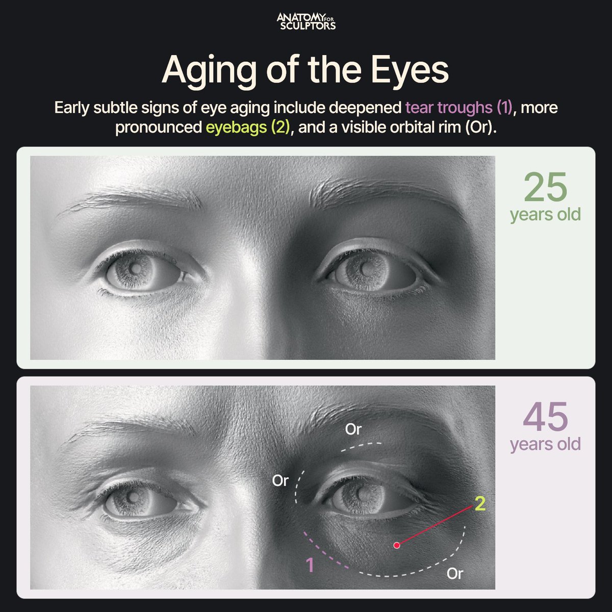 Early eye aging is driven by decreasing orbital fat. When character designers depict this, they need to keep in mind that as volume thins, tear troughs deepen, eyebags become more pronounced, and the orbital rim becomes exposed as a bony landmark. #anatomy #3dmodeling
