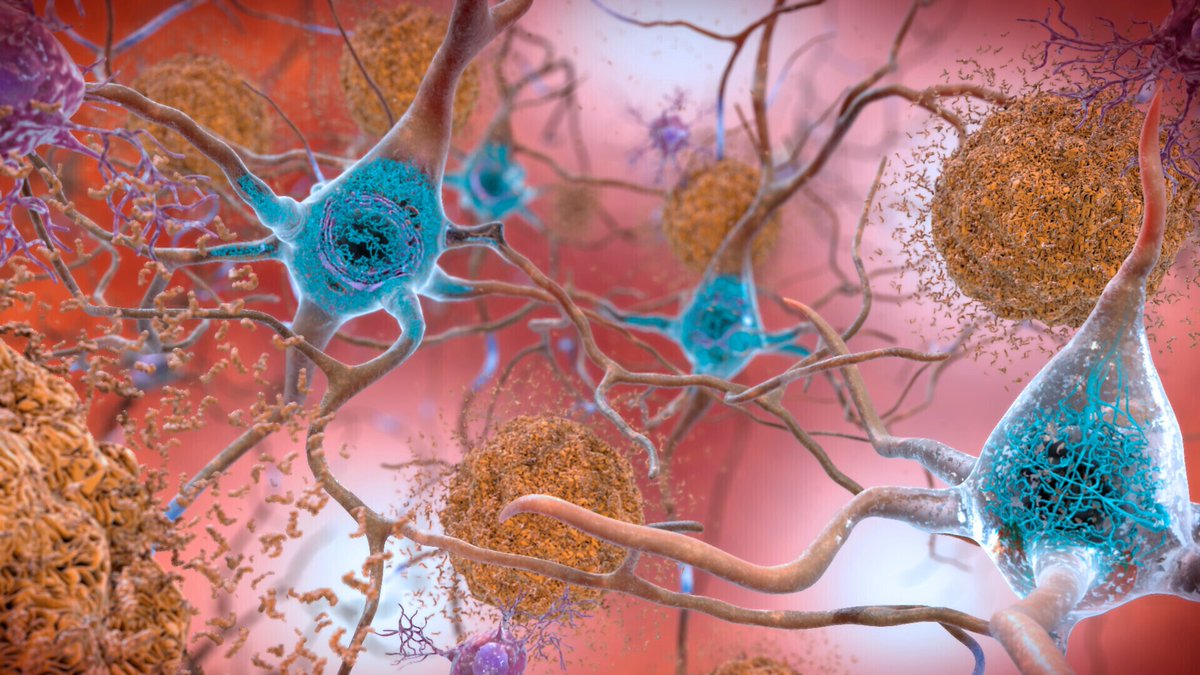 NUEVA ERA CONTRA EL ALZHEIMER: LLEGAN FÁRMACOS QUE FRENAN LA PROGRESIÓN Y AVANZA EL DIAGNÓSTICO PRECOZ CON ANÁLISIS DE SANGRE

Neurólogos destacan que la década actual marca un punto de inflexión en el Alzheimer: llegaron los primeros fármacos que frenan la progresión de la