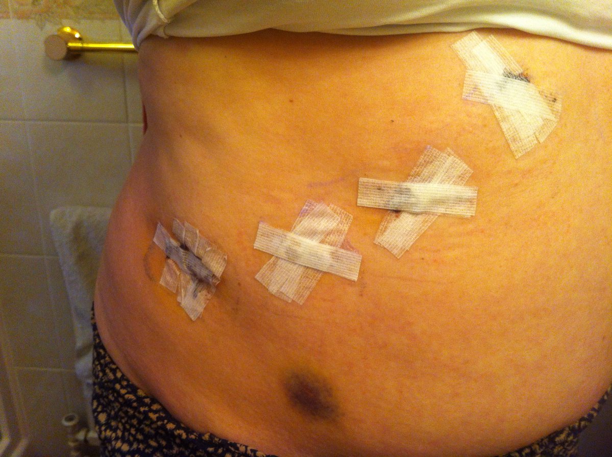 2026 and 2014…February must be a month of photographing scars!! Unfiltered just like me eeeek #proud (and thankful) 🙏🏻