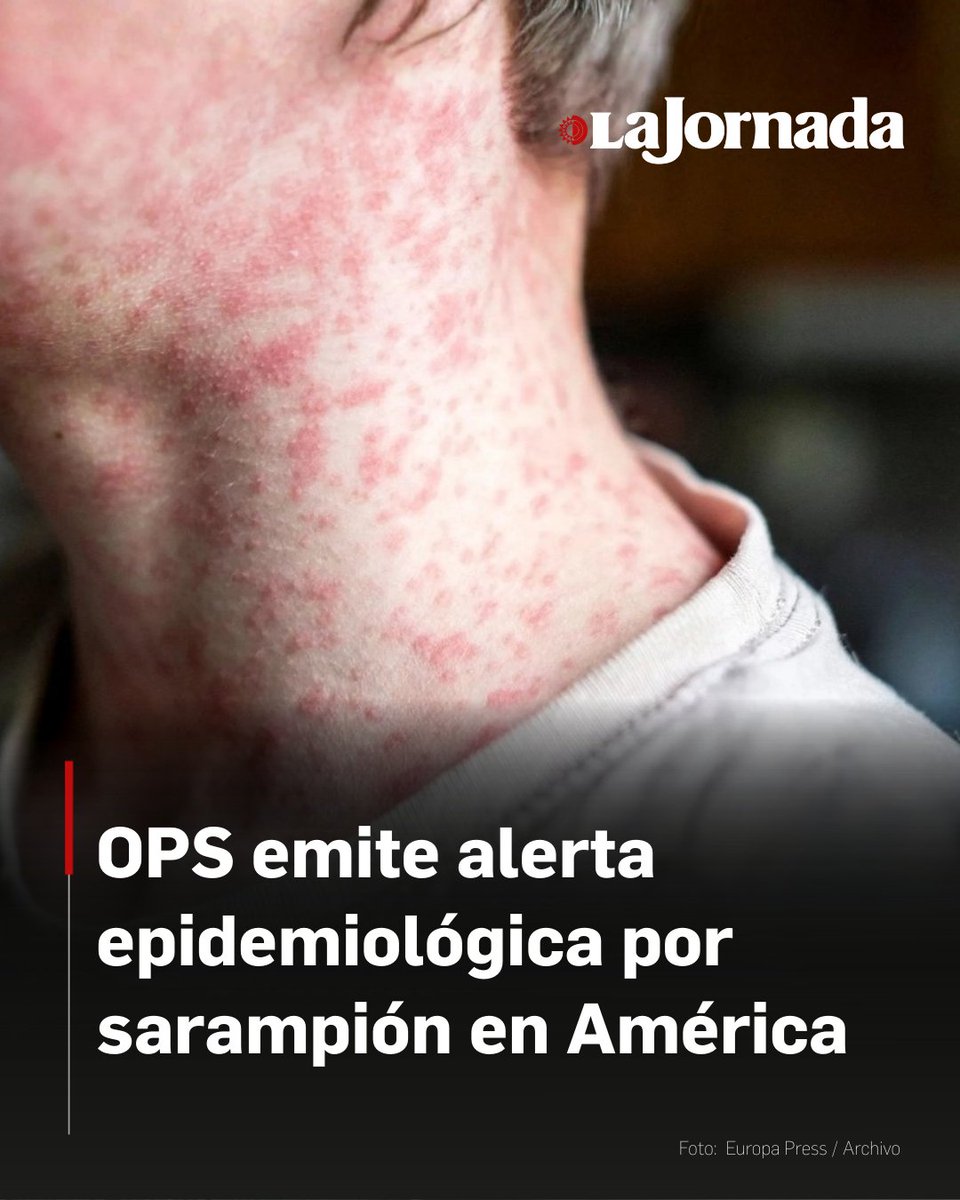 La Organización Panamericana de la Salud (OPS) hizo un llamado urgente a los países de las Américas tras detectar un resurgimiento masivo del sarampión. En 2025, los casos en la región aumentaron 32 veces respecto al año anterior.

México se posiciona como el país más afectado,