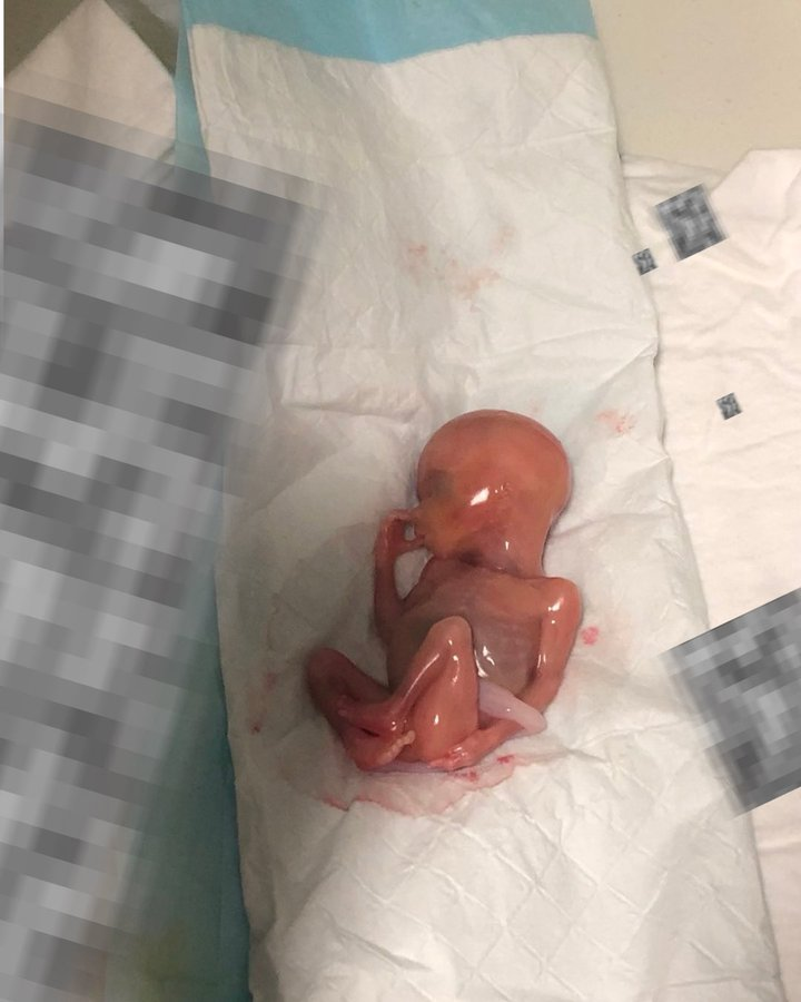This is Baby Samuel, who was born alive after a botched abortion at 16 weeks.

He sucked his thumb for 30 minutes before he died.

Absolutely heartbreaking. We must end abortion.

h/t <a href="/ProfJoannaHowe/">Dr Joanna Howe</a>