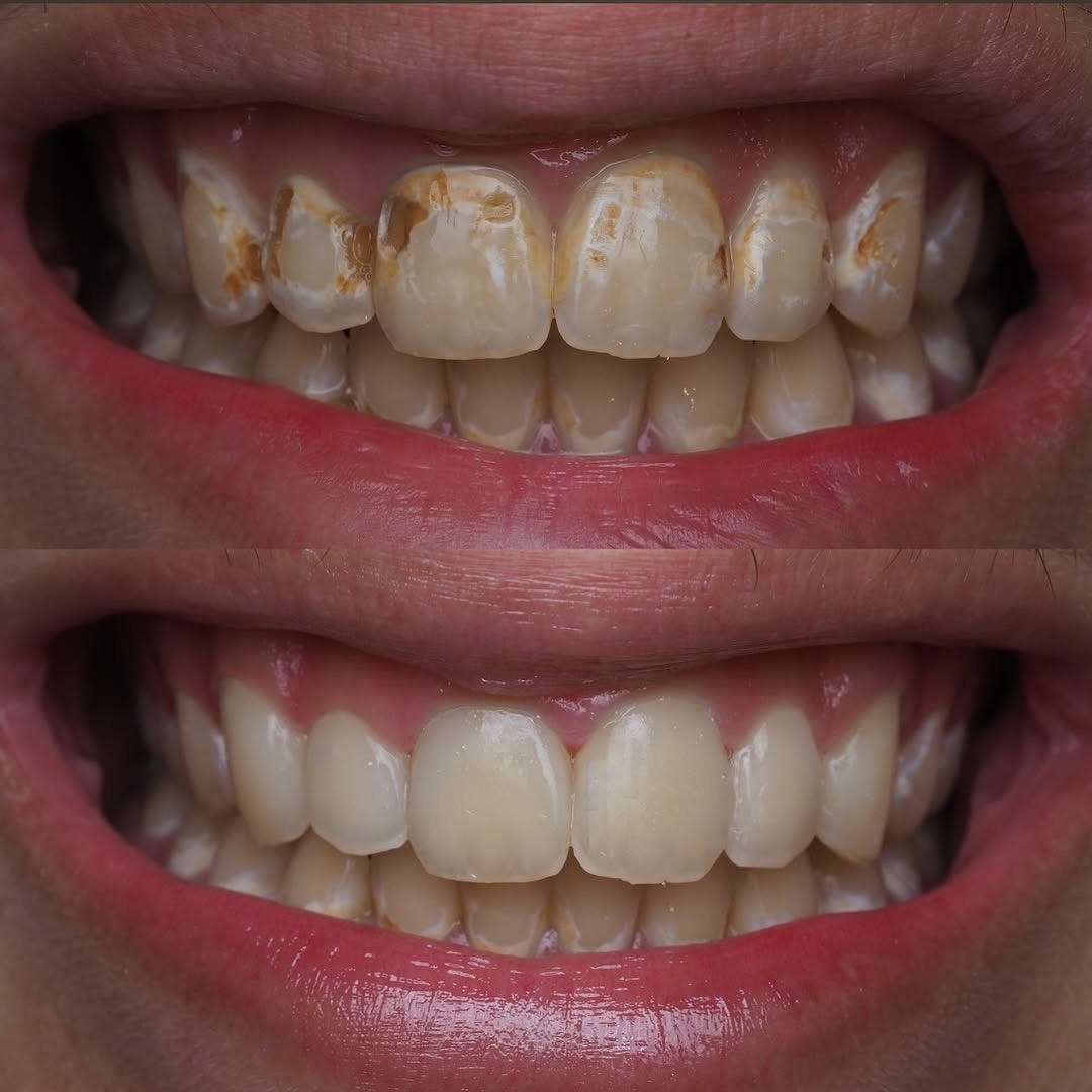 “🤩 Life changing teeth restoration. This patient grew up drinking 🥤 soda for breakfast, lunch and dinner. 

🫡 We went with a conservative treatment route of 🦷 composite bonding due to age and budget." -Dr. Richard Lam, 📸: refinedentistry
.
#tokuyama composite was used.