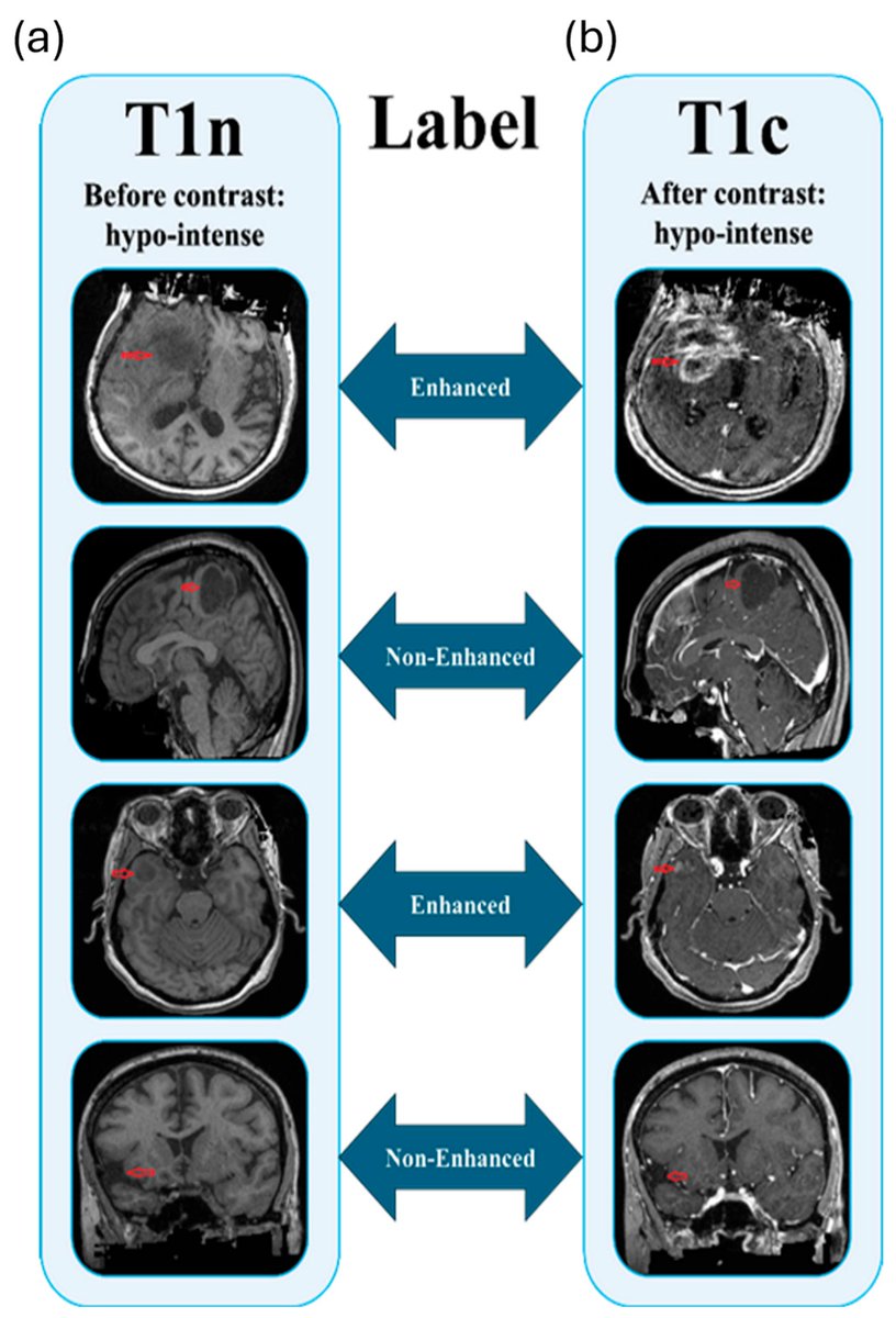 ✨New publication in #Inventions!
📑Enhancement Without Contrast: Stability-Aware Multicenter Machine Learning for Glioma MRI Imaging
👨‍🔬Amiri, S. et al.

🔗mdpi.com/2411-5134/11/1…

#ContrastEnhancement #GadoliniumfreeImaging #Radiomics #MachineLearning #MulticenterValidation