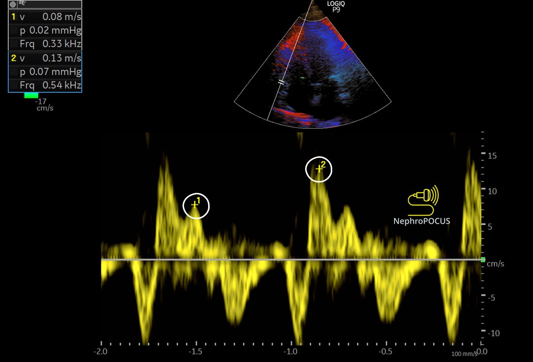 NephroPOCUS tweet media