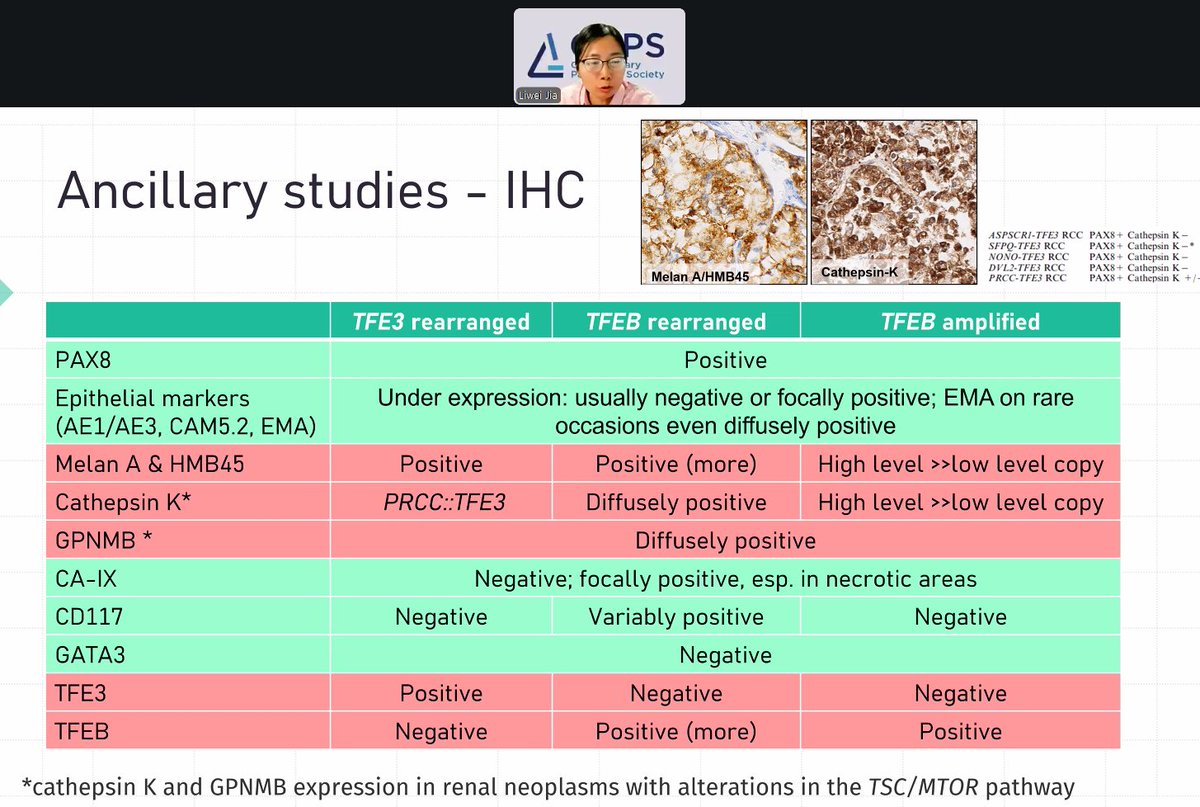 GU_Path_Society's tweet photo. A comprehensive IHC guide to recognition of challenging renal tumors by Dr. Jia!
#GUPath
https://t.co/0XweIHLIWb https://t.co/47dQiMMFXB