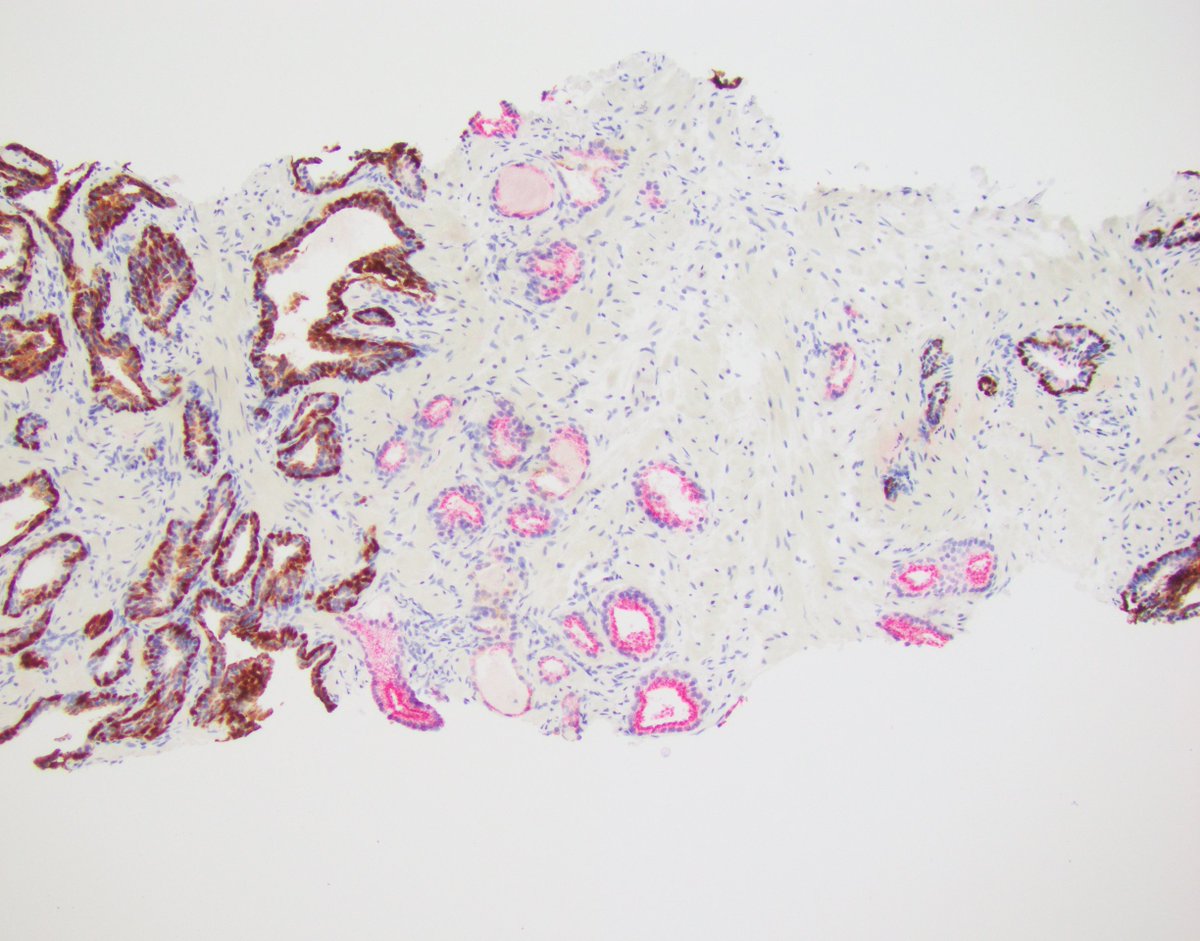 LaraHarikMD's tweet photo. Stain is PIN3
My diagnosis: ASAP
Lesson 1: when in doubt, do the stains
Lesson 2: Dont diagnose PCA unless you are sure!
#prostate #GUPATH #pathology #pathres https://t.co/hG8xdcohT8